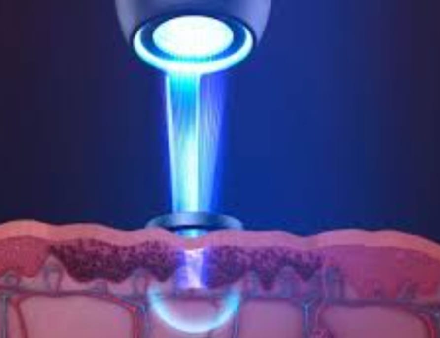 Lápiz Láser De Terapia Con Luz Azul De Picosegundo