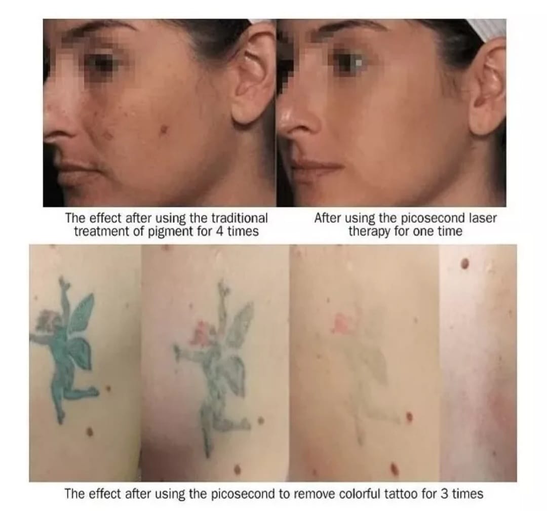 Lápiz Láser De Terapia Con Luz Azul De Picosegundo