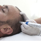 Microneedling Capilar