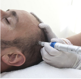 Microneedling Capilar