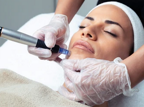 Microneedling Facial o Corporal