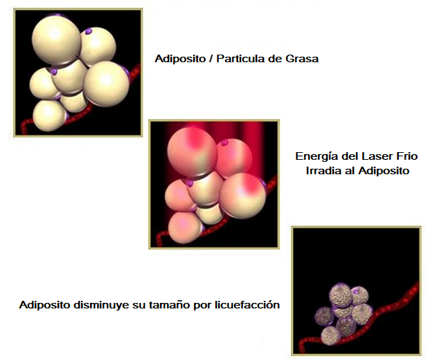 Lipolaser