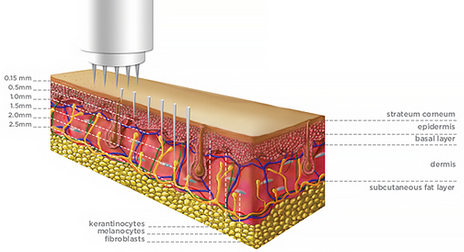 Microneedling Facial o Corporal