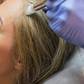 Microneedling Capilar