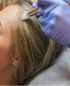 Microneedling Capilar