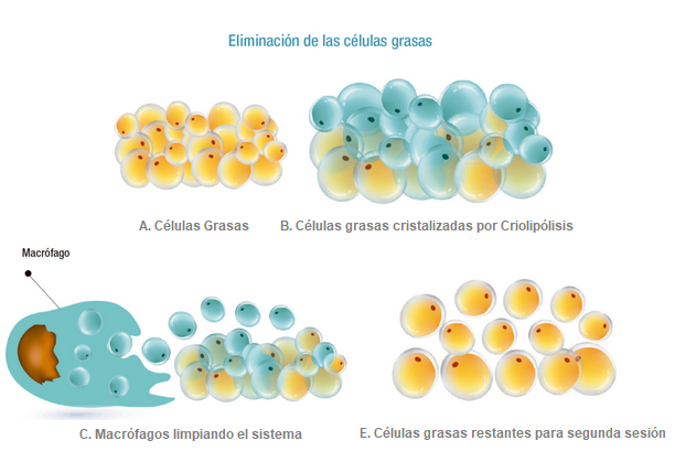 Criolipólisis